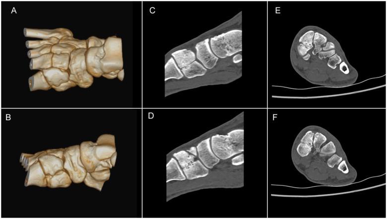 https://cdn.ncbi.nlm.nih.gov/pmc/blobs/7553/9528048/da2262f36063/10.1177_24730114221127192-fig2.jpg