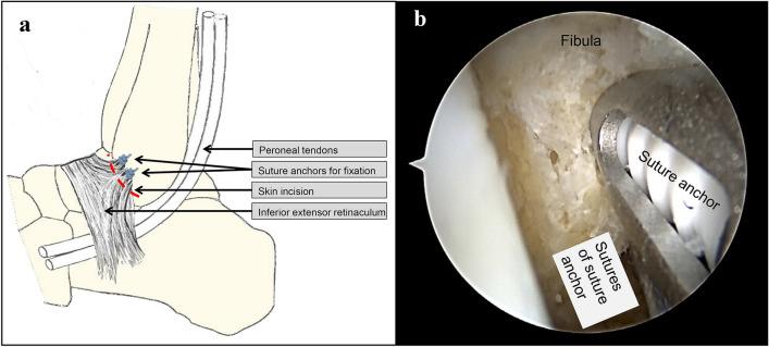 https://cdn.ncbi.nlm.nih.gov/pmc/blobs/756b/9596524/9c14a35bcaf7/402_2021_3949_Fig1_HTML.jpg