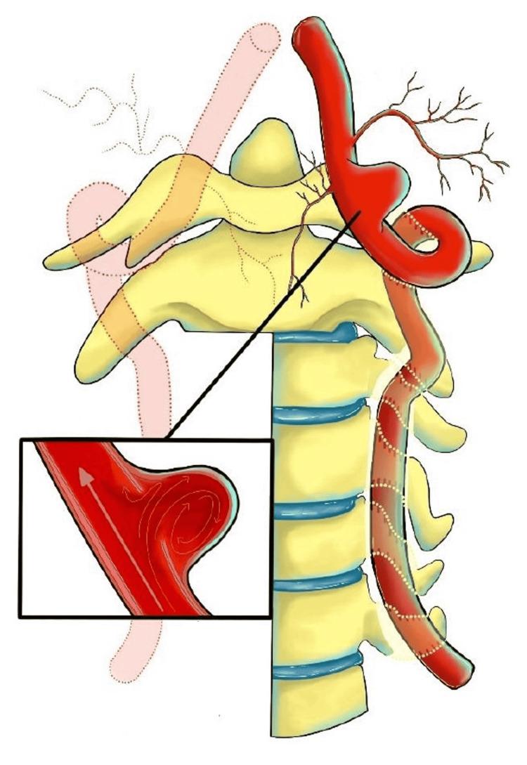 https://cdn.ncbi.nlm.nih.gov/pmc/blobs/756d/10757504/4d7b0620f115/cureus-0015-00000049716-i04.jpg