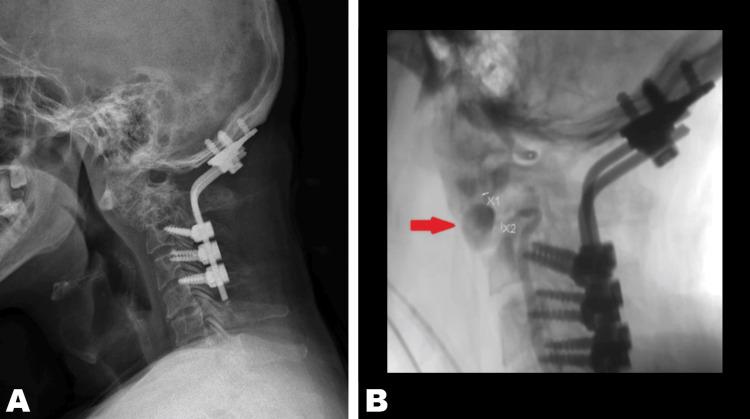 https://cdn.ncbi.nlm.nih.gov/pmc/blobs/756d/10757504/a91f839d8426/cureus-0015-00000049716-i03.jpg
