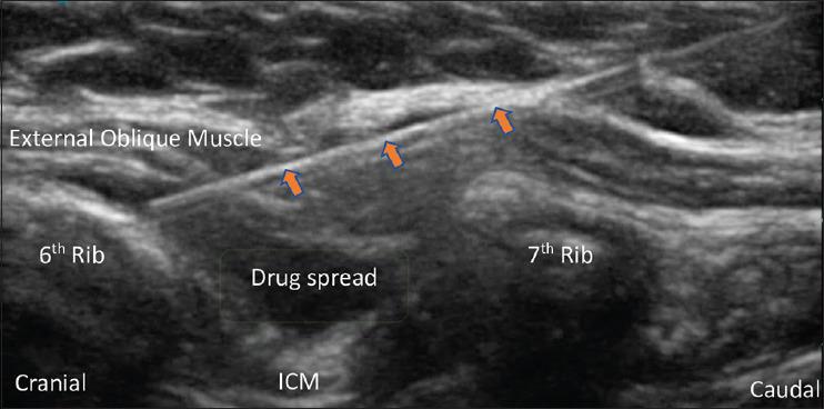 https://cdn.ncbi.nlm.nih.gov/pmc/blobs/7577/11626888/2206184069c0/IJA-68-965-g001.jpg