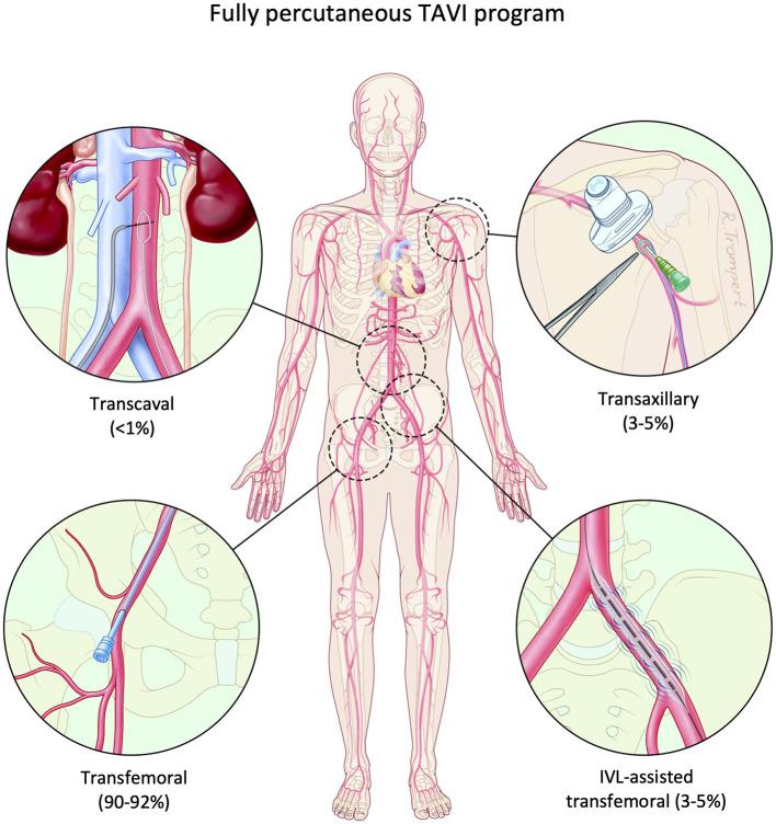 https://cdn.ncbi.nlm.nih.gov/pmc/blobs/7578/8492918/072cf3fb8713/fcvm-08-739750-g0001.jpg