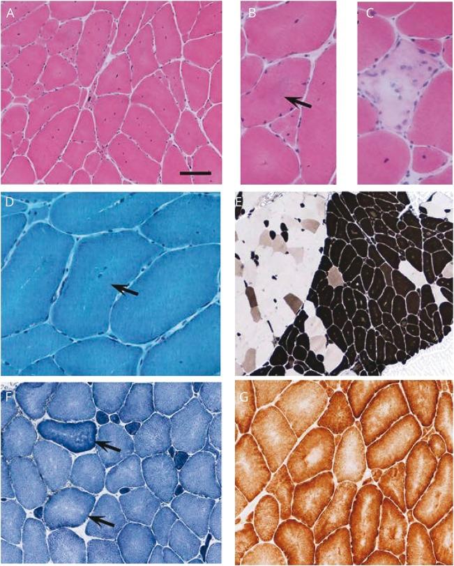 https://cdn.ncbi.nlm.nih.gov/pmc/blobs/75f2/5791790/95a657ae49ab/NEUROLOGY2017827741FF2.jpg