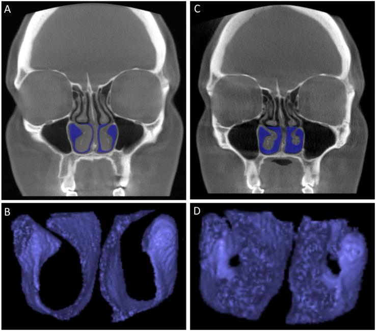 https://cdn.ncbi.nlm.nih.gov/pmc/blobs/75f9/9016672/20b74ee5a785/10.1177_00034894211028516-fig2.jpg