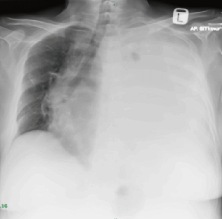 https://cdn.ncbi.nlm.nih.gov/pmc/blobs/7601/12145215/e8c116328ab1/cureus-0017-00000083751-i01.jpg