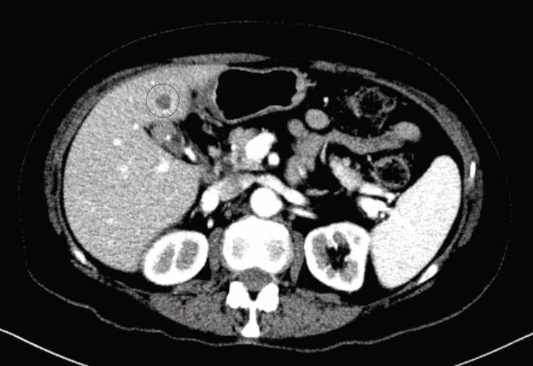 https://cdn.ncbi.nlm.nih.gov/pmc/blobs/762a/9236677/91d924032917/cureus-0014-00000025361-i02.jpg
