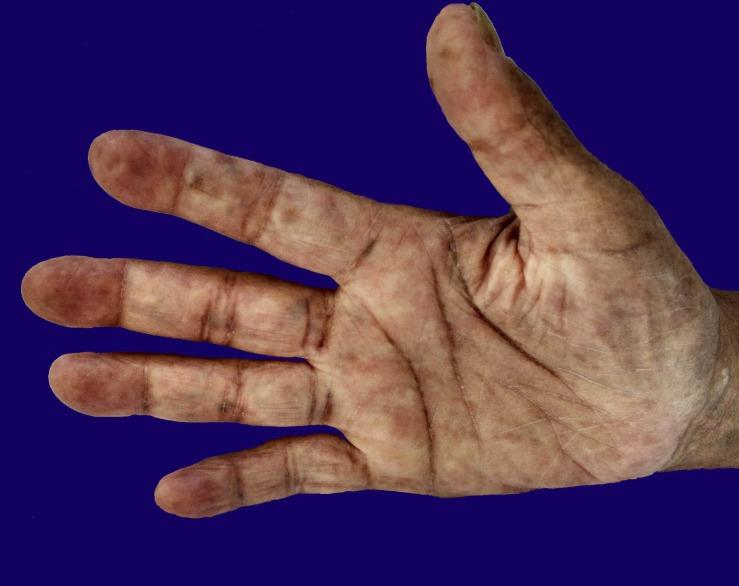 https://cdn.ncbi.nlm.nih.gov/pmc/blobs/7660/5634435/dee11362ba4a/autopsy-07-03050-g01.jpg