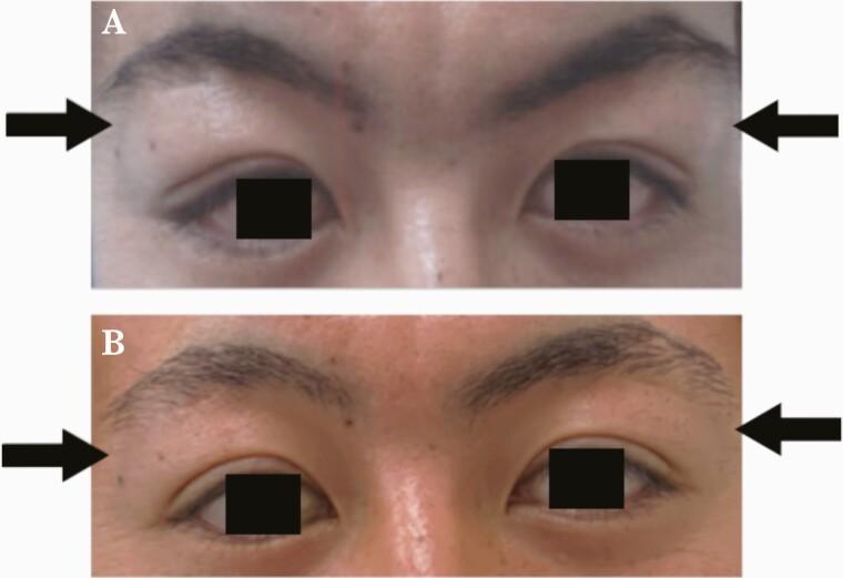 https://cdn.ncbi.nlm.nih.gov/pmc/blobs/7665/8962688/64f16a965b4a/ofac086_fig1.jpg