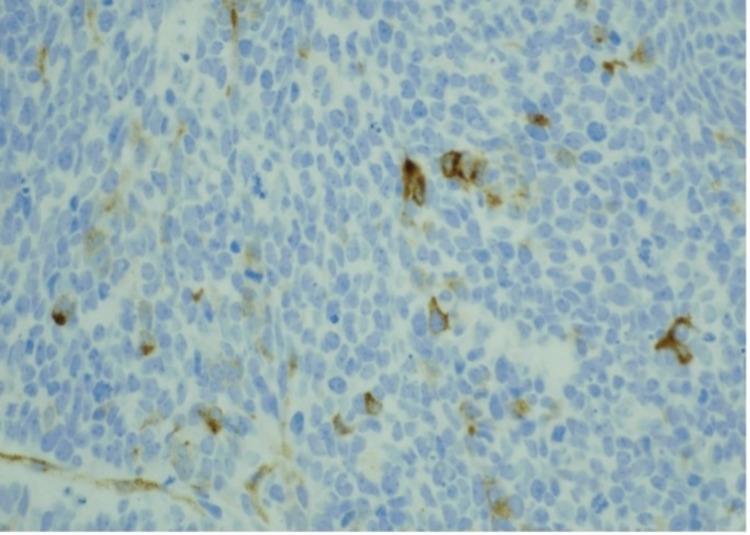 https://cdn.ncbi.nlm.nih.gov/pmc/blobs/769e/9135308/8f9177b108c4/cureus-0014-00000024505-i04.jpg