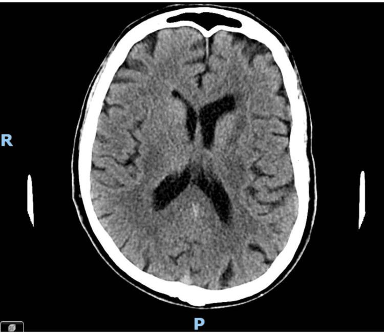 https://cdn.ncbi.nlm.nih.gov/pmc/blobs/76c4/12103919/5645ae31ff5b/cureus-0017-00000082987-i01.jpg