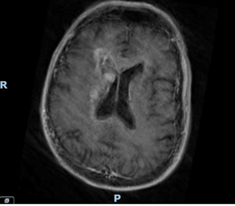 https://cdn.ncbi.nlm.nih.gov/pmc/blobs/76c4/12103919/75e26f548cd7/cureus-0017-00000082987-i02.jpg