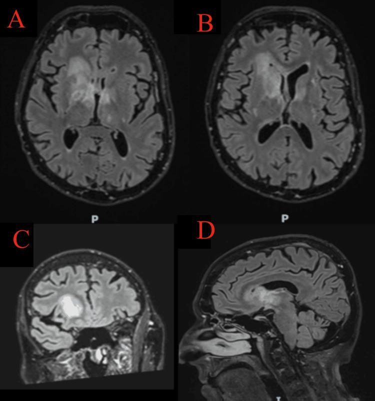 https://cdn.ncbi.nlm.nih.gov/pmc/blobs/76c4/12103919/cb542110f72b/cureus-0017-00000082987-i03.jpg