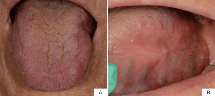 https://cdn.ncbi.nlm.nih.gov/pmc/blobs/7757/12395392/4f791e06f8b7/cureus-0017-00000089045-i09.jpg