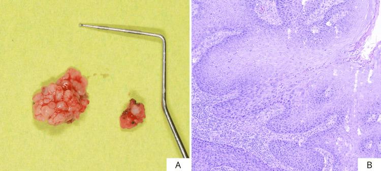 https://cdn.ncbi.nlm.nih.gov/pmc/blobs/7757/12395392/7229324d3826/cureus-0017-00000089045-i02.jpg