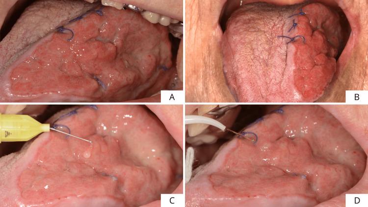 https://cdn.ncbi.nlm.nih.gov/pmc/blobs/7757/12395392/72cc05b7196b/cureus-0017-00000089045-i07.jpg