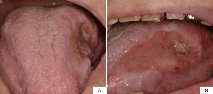 https://cdn.ncbi.nlm.nih.gov/pmc/blobs/7757/12395392/b2b5d3d15304/cureus-0017-00000089045-i08.jpg