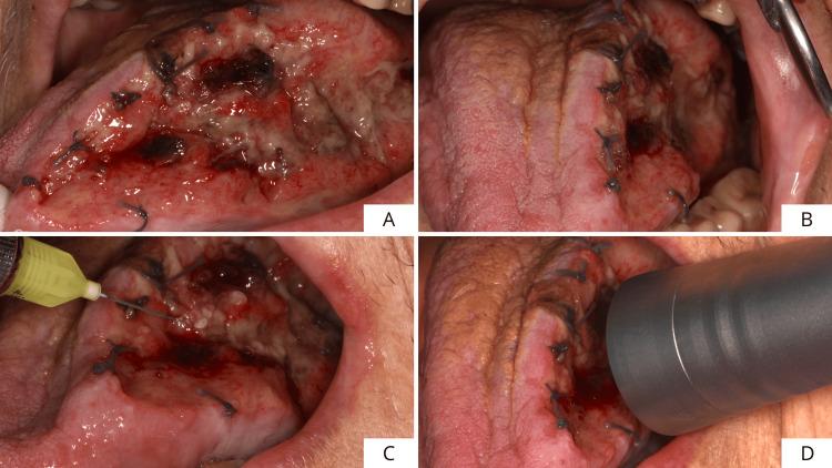 https://cdn.ncbi.nlm.nih.gov/pmc/blobs/7757/12395392/cb27f70603ca/cureus-0017-00000089045-i06.jpg