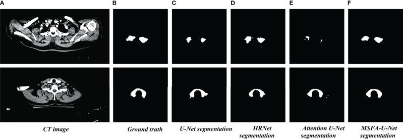 https://cdn.ncbi.nlm.nih.gov/pmc/blobs/776d/9204279/96f226252d9d/fonc-12-844052-g004.jpg