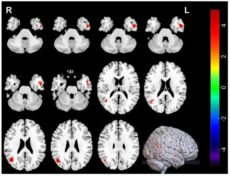 https://cdn.ncbi.nlm.nih.gov/pmc/blobs/777a/9496677/1079a067fd5d/brainsci-12-01121-g004.jpg
