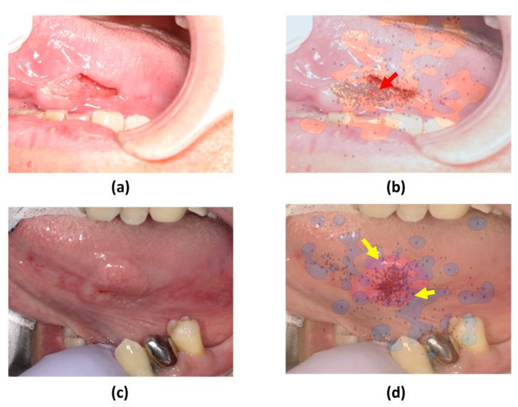 https://cdn.ncbi.nlm.nih.gov/pmc/blobs/77a3/10780288/64ae78ef1687/jcm-13-00136-g006.jpg