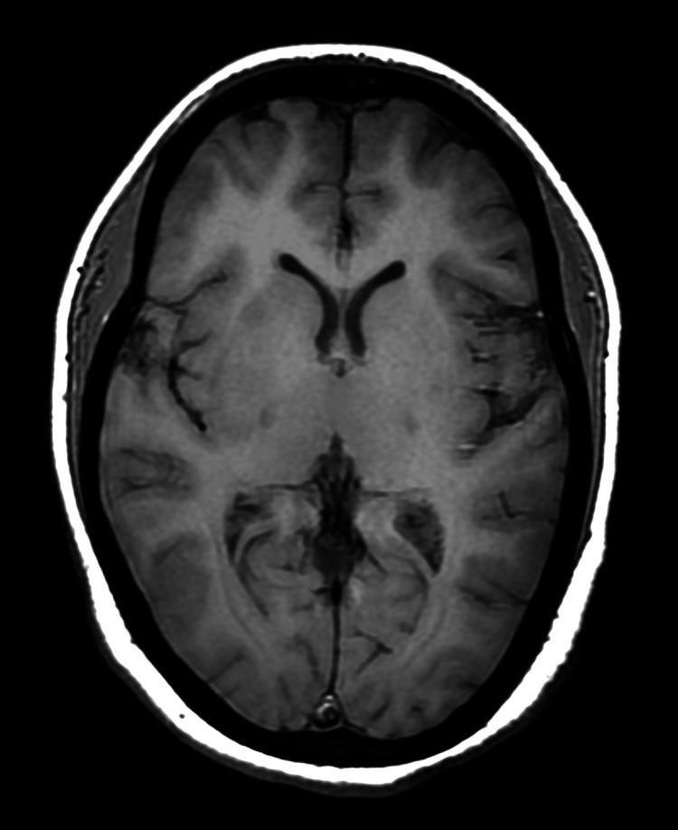 https://cdn.ncbi.nlm.nih.gov/pmc/blobs/77b3/11348870/1014c734054b/cureus-0016-00000065290-i04.jpg