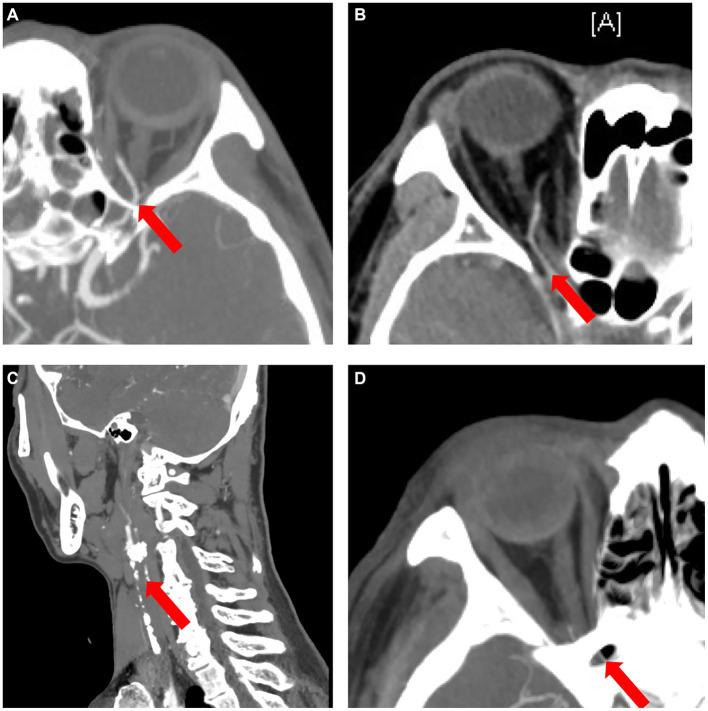 https://cdn.ncbi.nlm.nih.gov/pmc/blobs/7802/11298379/44df95496ee7/fmed-11-1334455-g008.jpg