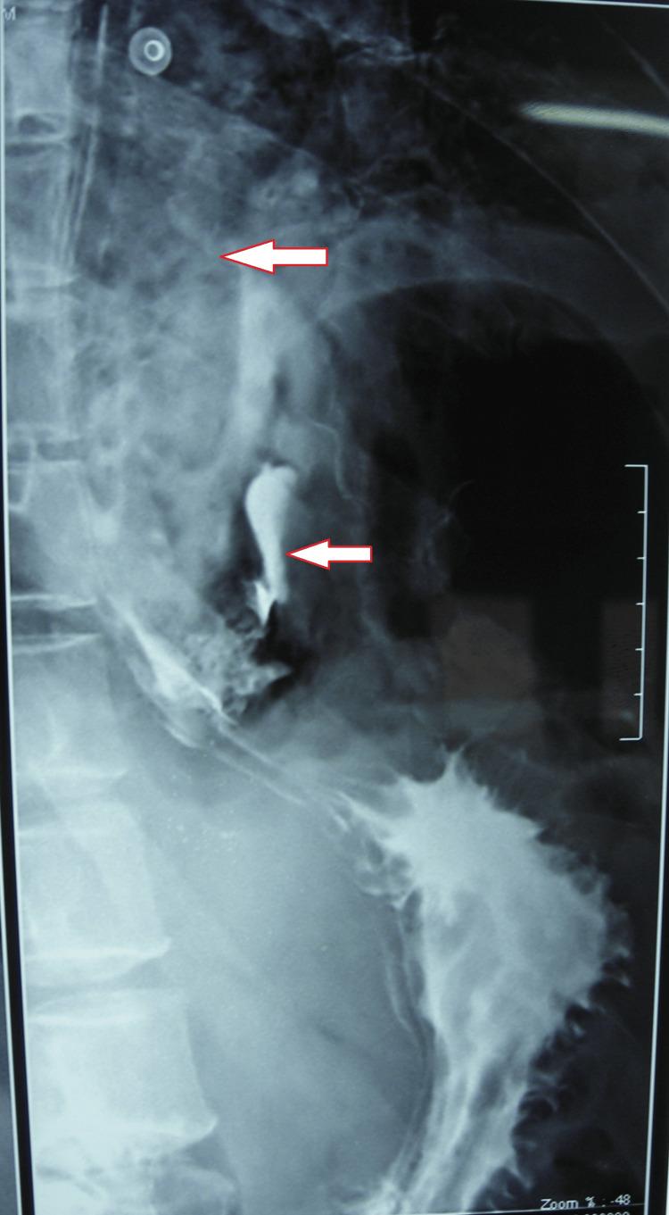 https://cdn.ncbi.nlm.nih.gov/pmc/blobs/7804/10981385/1125df0e19a4/cureus-0016-00000055225-i03.jpg