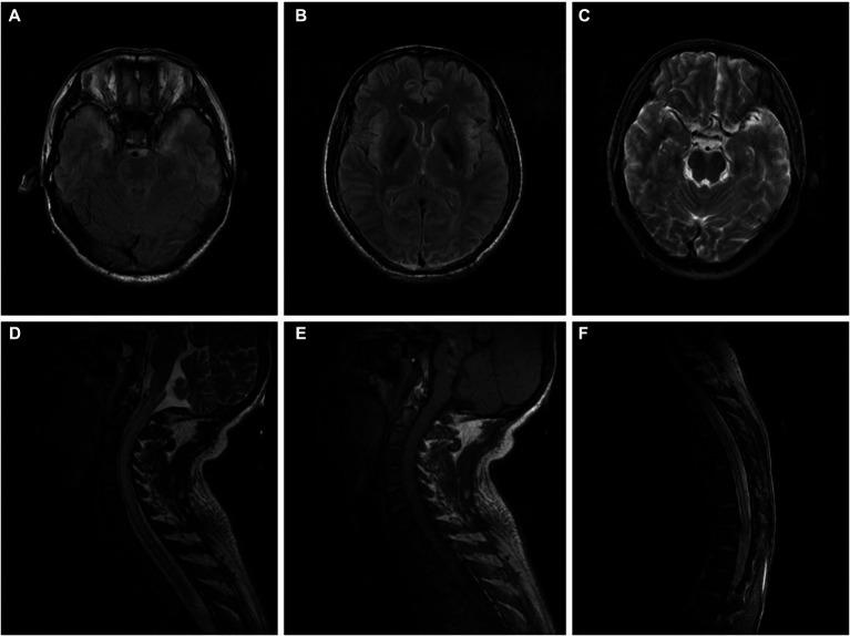 https://cdn.ncbi.nlm.nih.gov/pmc/blobs/789d/10313390/43fc66e9154b/fneur-14-1121421-g001.jpg