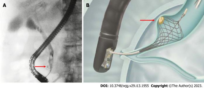 https://cdn.ncbi.nlm.nih.gov/pmc/blobs/78ea/10122794/73bf72bde866/WJG-29-1955-g003.jpg