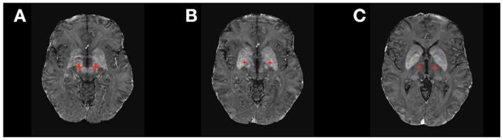 https://cdn.ncbi.nlm.nih.gov/pmc/blobs/791b/8340024/87f4bbc2a949/fneur-12-694747-g0001.jpg