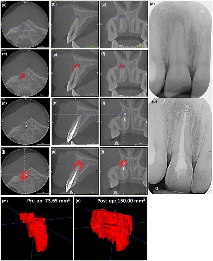 https://cdn.ncbi.nlm.nih.gov/pmc/blobs/7954/12160989/772cddcc0160/IEJ-58-965-g006.jpg