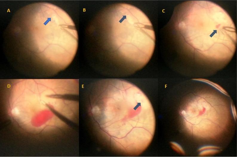 https://cdn.ncbi.nlm.nih.gov/pmc/blobs/796a/5937505/932d4716b663/imcrj-11-105Fig6.jpg
