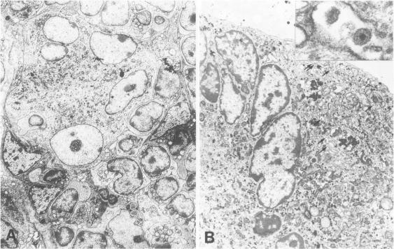 https://cdn.ncbi.nlm.nih.gov/pmc/blobs/796d/1887226/76557732b0f8/amjpathol00069-0065-a.jpg