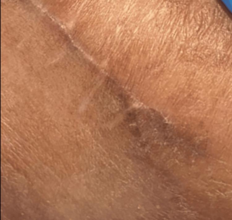 https://cdn.ncbi.nlm.nih.gov/pmc/blobs/79bd/12367565/cf001bce0ce3/cureus-0017-00000088471-i08.jpg
