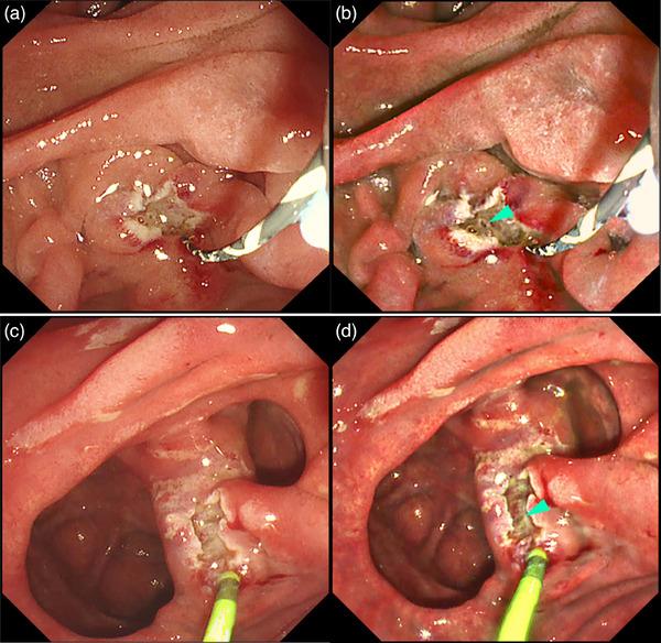 https://cdn.ncbi.nlm.nih.gov/pmc/blobs/79f2/11091847/04296fbcbcad/DEO2-5-e382-g009.jpg