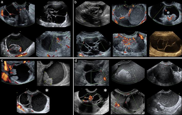 https://cdn.ncbi.nlm.nih.gov/pmc/blobs/79f2/7839489/90d5d3f748fa/UOG-57-155-g003.jpg