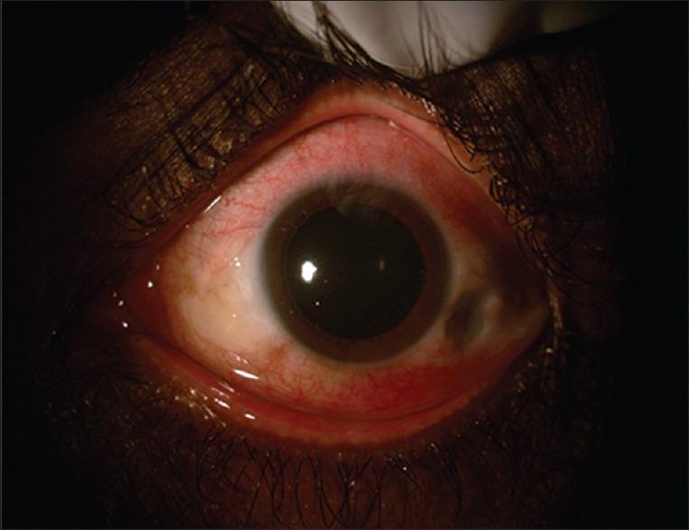 https://cdn.ncbi.nlm.nih.gov/pmc/blobs/7a39/4738672/398fa6b39549/OJO-8-200-g002.jpg