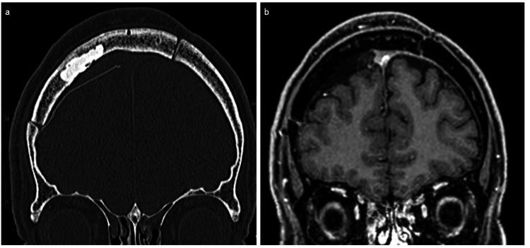 https://cdn.ncbi.nlm.nih.gov/pmc/blobs/7a59/12180386/0c16cb2196ce/cureus-0017-00000084536-i04.jpg