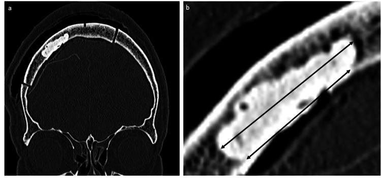 https://cdn.ncbi.nlm.nih.gov/pmc/blobs/7a59/12180386/204ec400ee6d/cureus-0017-00000084536-i03.jpg
