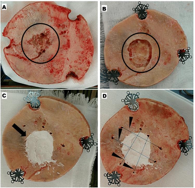 https://cdn.ncbi.nlm.nih.gov/pmc/blobs/7a59/12180386/bcbcf64cba3e/cureus-0017-00000084536-i02.jpg