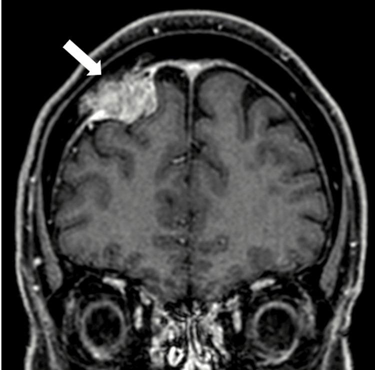 https://cdn.ncbi.nlm.nih.gov/pmc/blobs/7a59/12180386/e86f9921c64c/cureus-0017-00000084536-i01.jpg