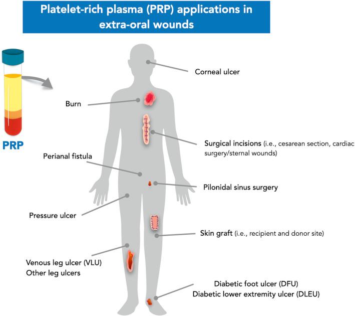 https://cdn.ncbi.nlm.nih.gov/pmc/blobs/7a65/11808476/b2f0ba03f575/PRD-97-320-g001.jpg