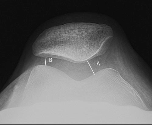 https://cdn.ncbi.nlm.nih.gov/pmc/blobs/7a6b/3445133/1235dcbdf571/10.1177_1941738110397875-fig12.jpg