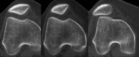 https://cdn.ncbi.nlm.nih.gov/pmc/blobs/7a6b/3445133/155197bfd54e/10.1177_1941738110397875-fig15.jpg