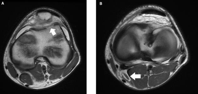 https://cdn.ncbi.nlm.nih.gov/pmc/blobs/7a6b/3445133/5b137520c507/10.1177_1941738110397875-fig22.jpg
