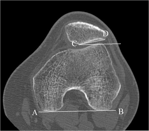 https://cdn.ncbi.nlm.nih.gov/pmc/blobs/7a6b/3445133/b0f830343dc0/10.1177_1941738110397875-fig13.jpg