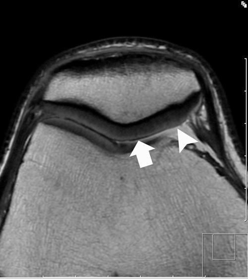 https://cdn.ncbi.nlm.nih.gov/pmc/blobs/7a6b/3445133/d259302d4b58/10.1177_1941738110397875-fig28.jpg