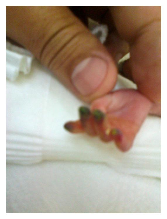 https://cdn.ncbi.nlm.nih.gov/pmc/blobs/7a89/3819912/008445022d85/CRIM.PEDIATRICS2013-608516.002.jpg