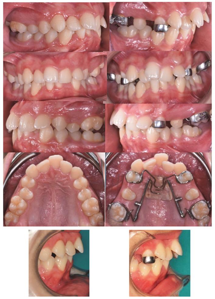 https://cdn.ncbi.nlm.nih.gov/pmc/blobs/7a9b/9600778/29b8f8422c0f/dentistry-10-00179-g007.jpg