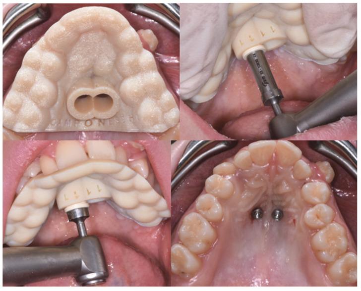 https://cdn.ncbi.nlm.nih.gov/pmc/blobs/7a9b/9600778/40182a7e7281/dentistry-10-00179-g003.jpg